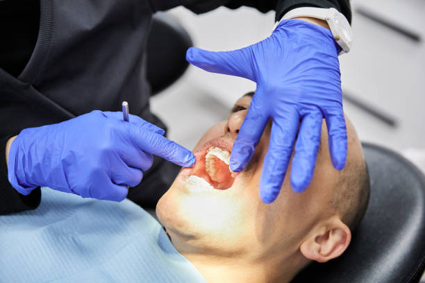 Best Emergency Wisdom Teeth Removal in Yorkvle, IL