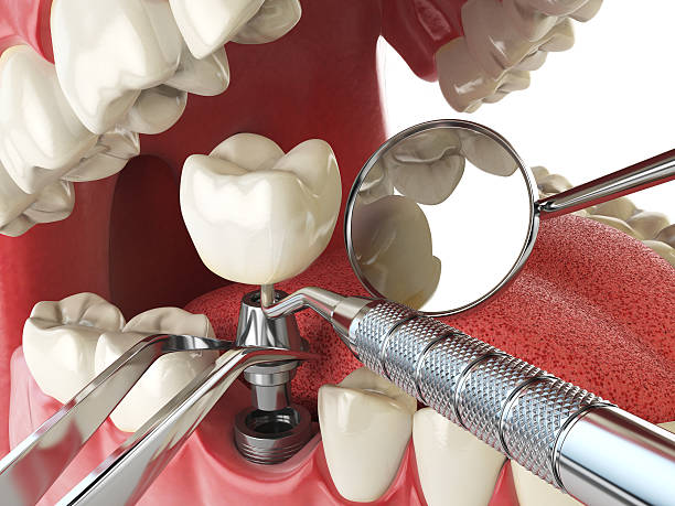 Best Emergency Tooth Extraction in Yorkvle, IL